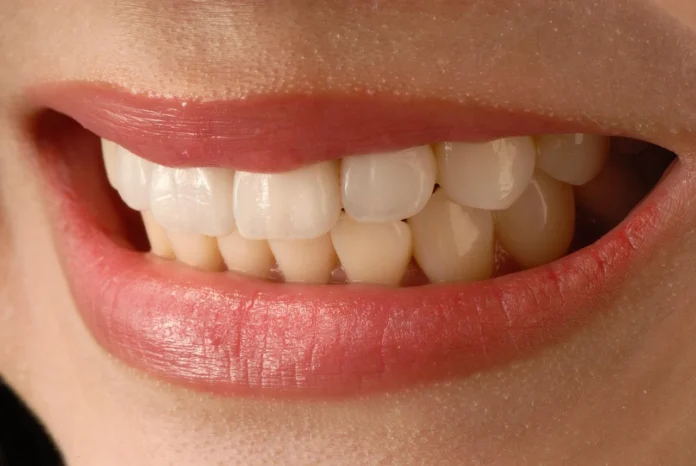 Ceramic Veneers